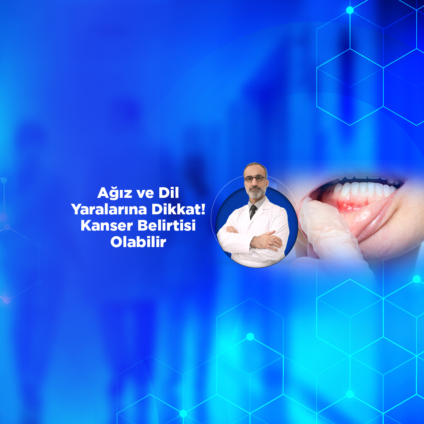 Ağız ve Dil Yaralarına Dikkat! Kanser Belirtisi Olabilir