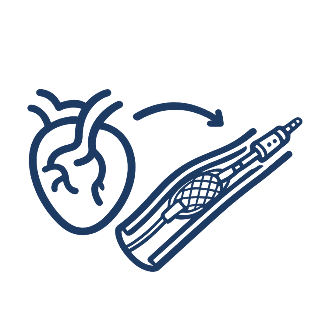 Perkütan Koroner Girişim