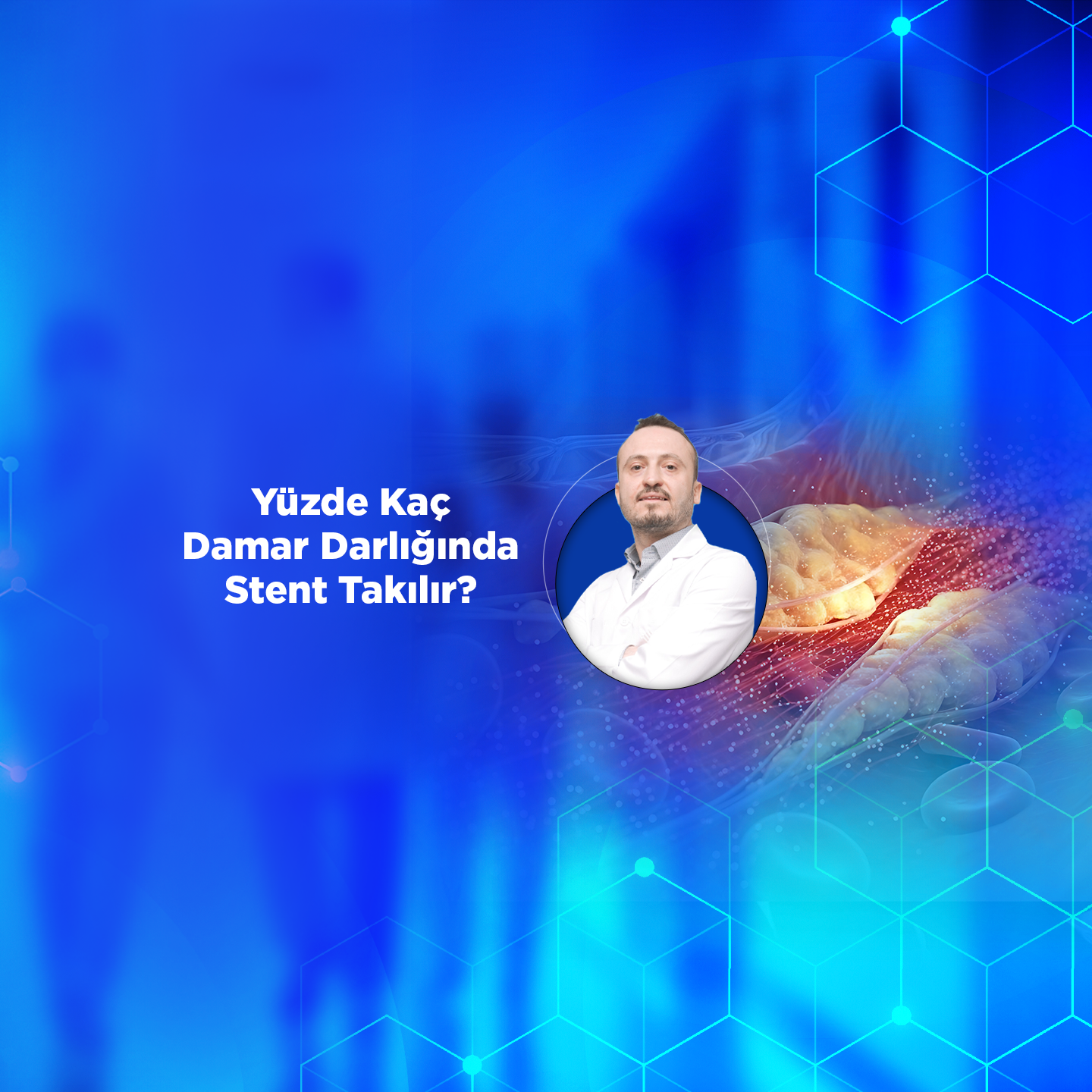 Yüzde Kaç Damar Darlığında Stent Takılır?