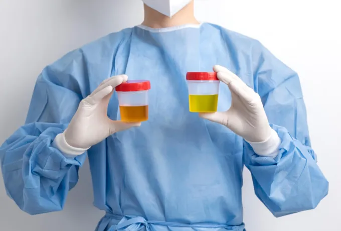 idrardan kan gelmesi hematüri nedir