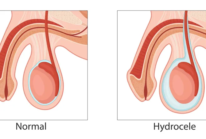 hidrosel su fıtığı