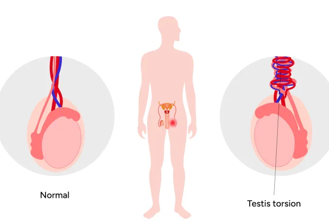 testis torsiyonu