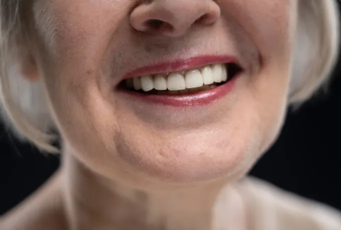 kancalı parsiyel diş protezi