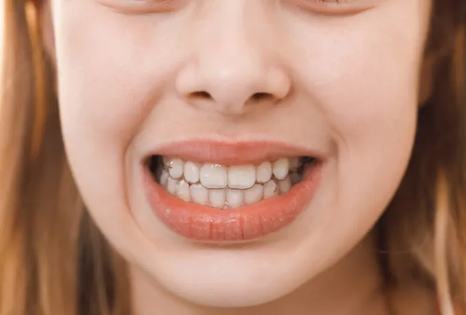 Maloklüzyon Nedir, Nasıl Tedavi Edilir?
