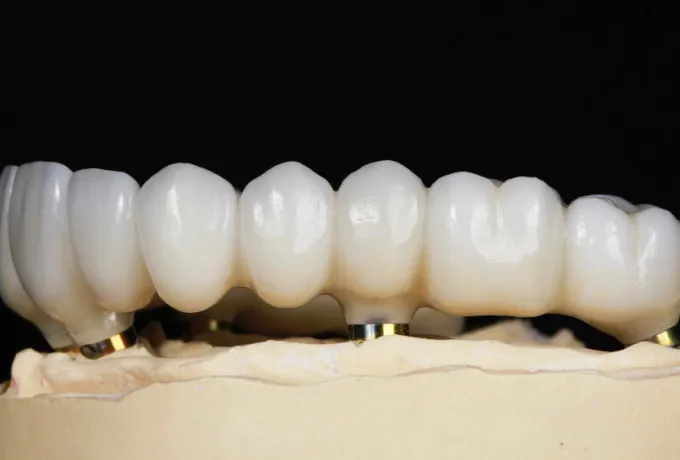 All On Six (All On 6) İmplant Tekniği