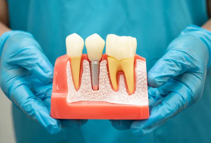 bütün dişlere implant yaptırılır mı