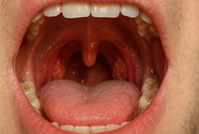 damak şişmesi nedenleri