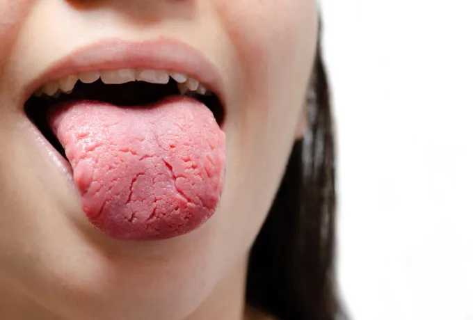 çatlak dil nasıl geçer