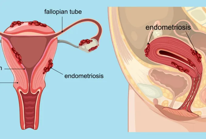 Endometriozis Çikolata Kisti