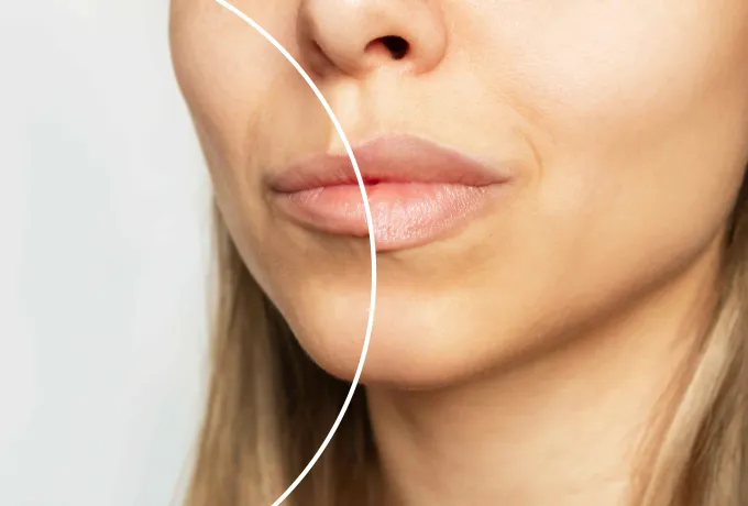 Dudak Kaldırma (Lip Lift) Ameliyatı