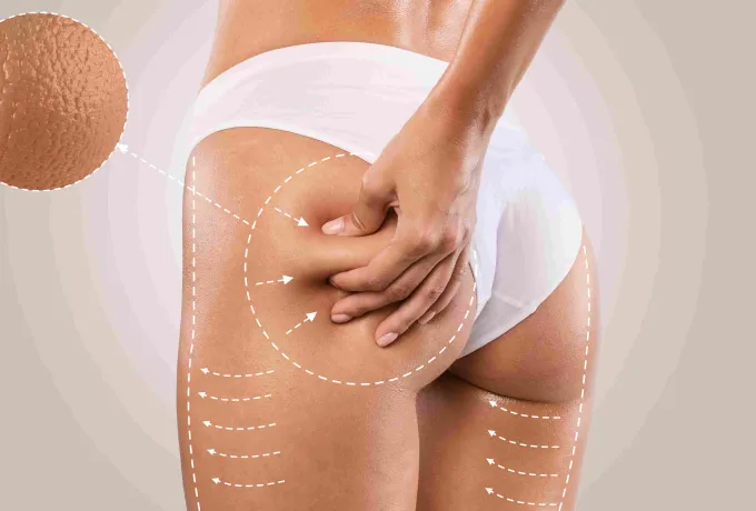 Alt Vücut Germe (Lower Body Lift)