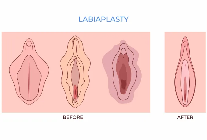 Labioplasti (İç Dudak Ameliyatı)