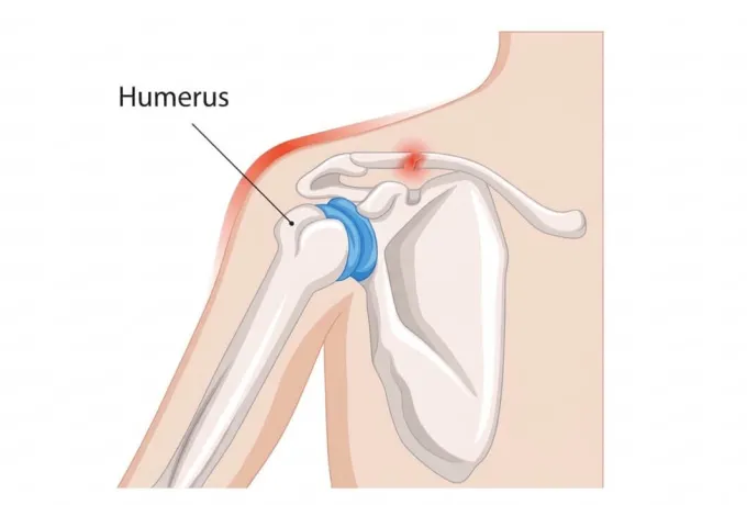 humerus tümörü