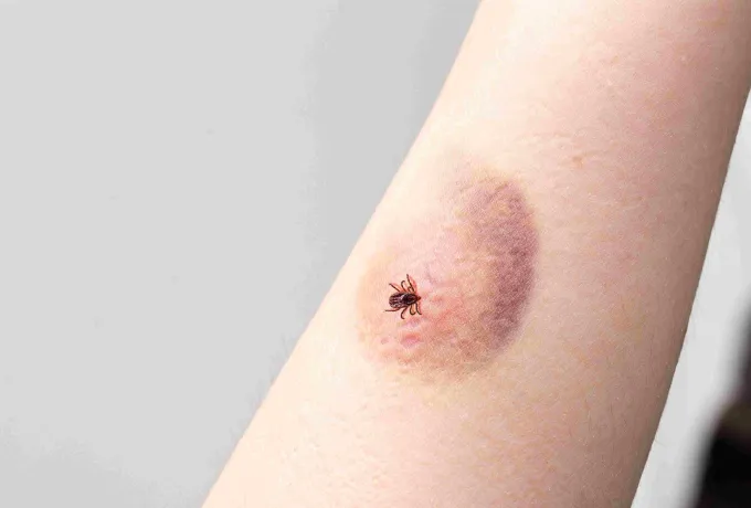 Kene Isırması Nedir? Kene Isırığı Belirtileri ve Tedavisi