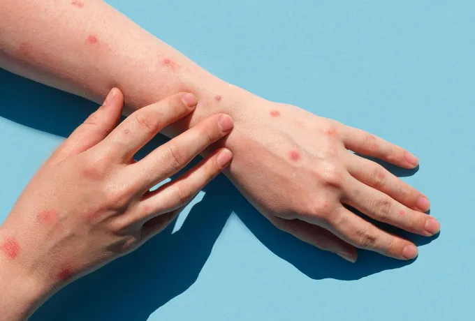 Maymun Çiçeği Virüsü (Monkeypox) Nedir? Belirtileri ve Korunma Yolları Nelerdir?