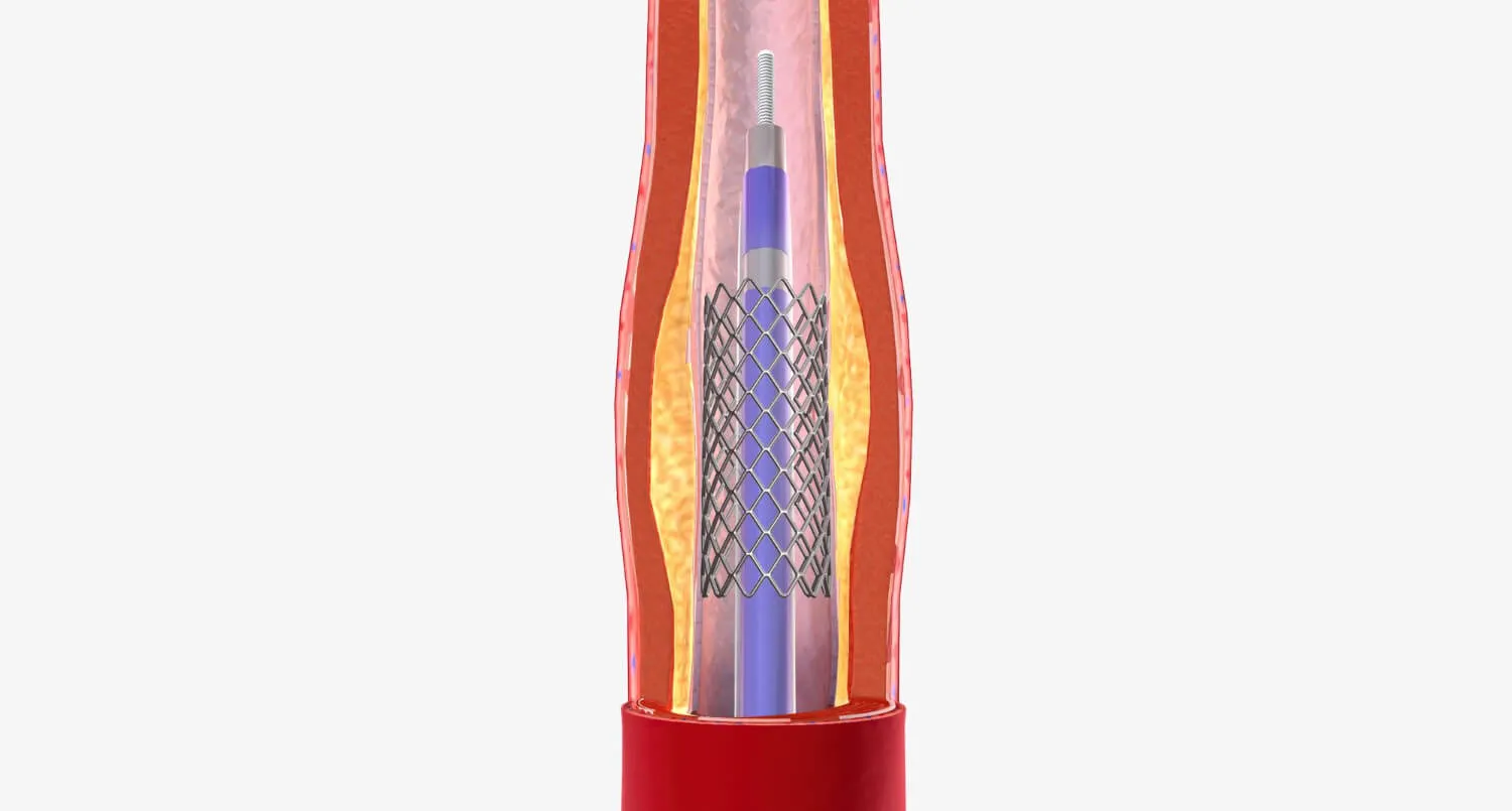 Balon ve Stent Uygulamaları Nedir, Nasıl Uygulanır?