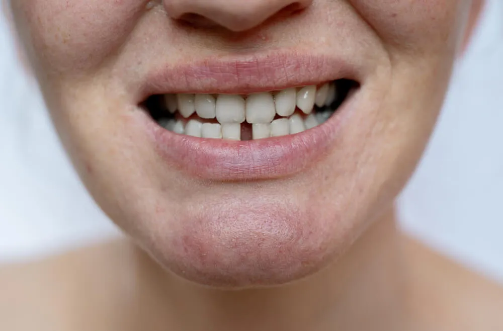 Maryland Diş Köprüsü Tedavisi Nedir