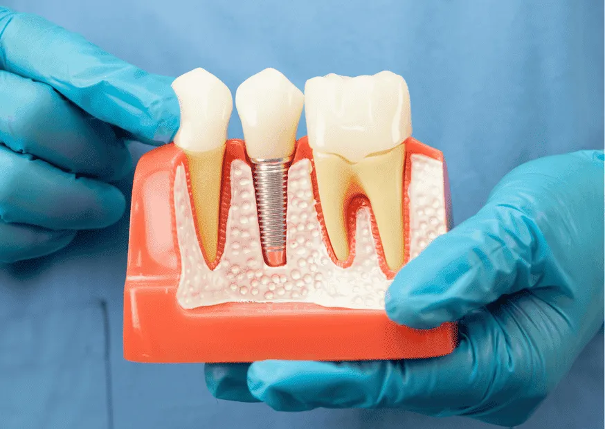 dis implantı kansere neden olur mu