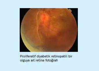 Bir gözüm diyabette!
