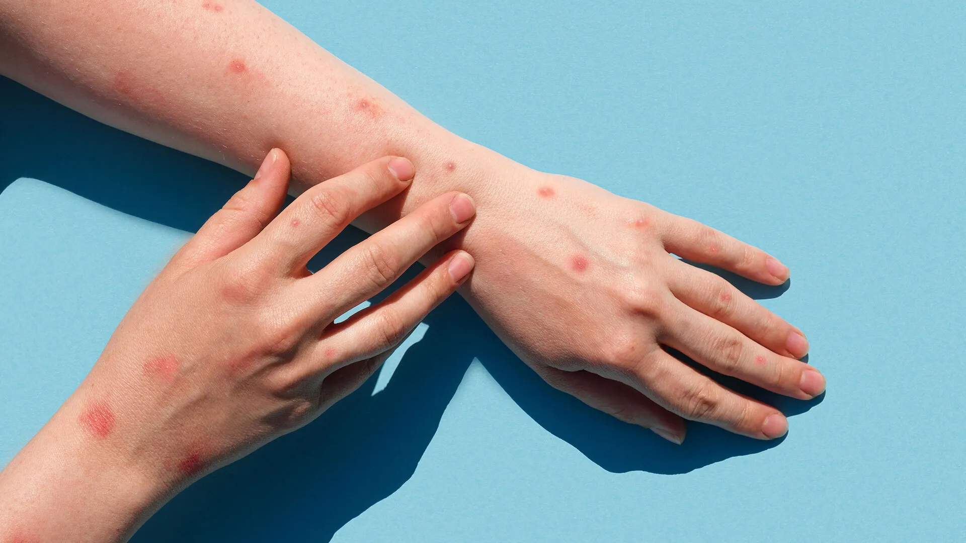 Maymun Çiçeği Virüsü (Monkeypox) Nedir? Belirtileri ve Korunma Yolları Nelerdir?