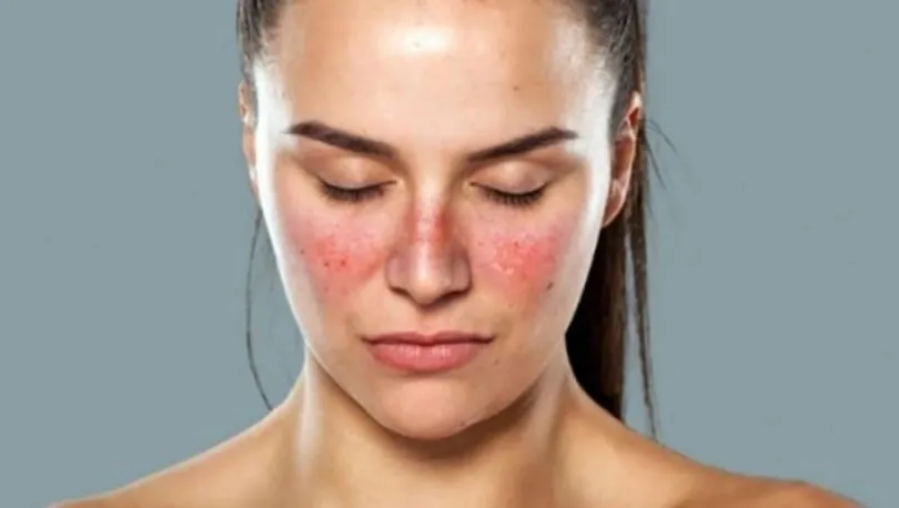 Lupus hastalığında kadınlar 9 kat daha fazla risk altında