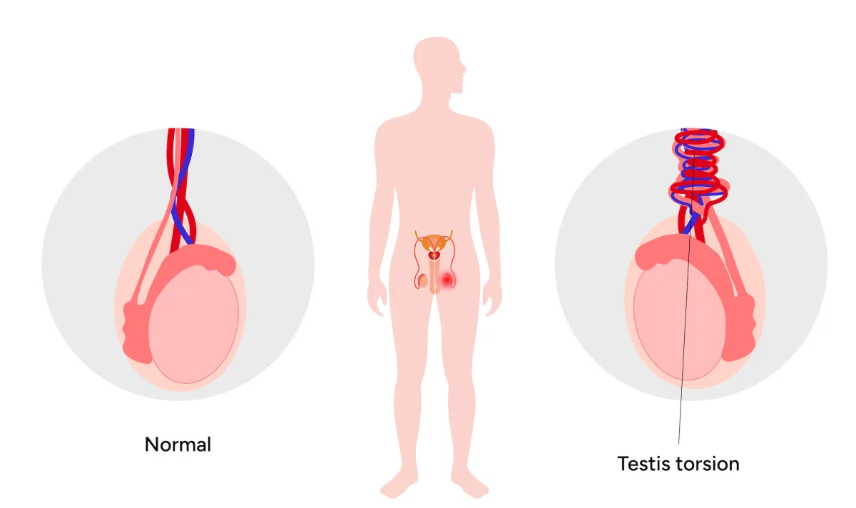 testis torsiyonu