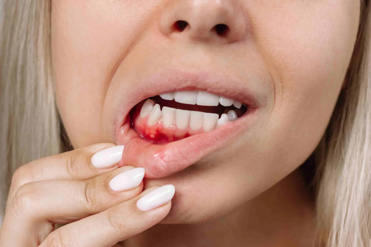 periodontitis 