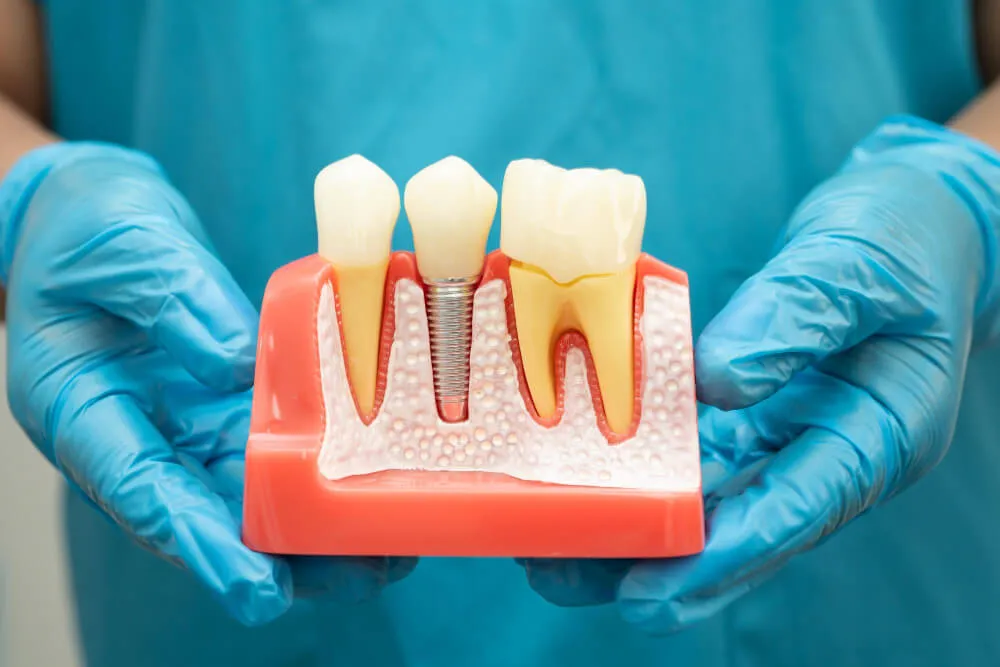 bütün dişlere implant yaptırılır mı