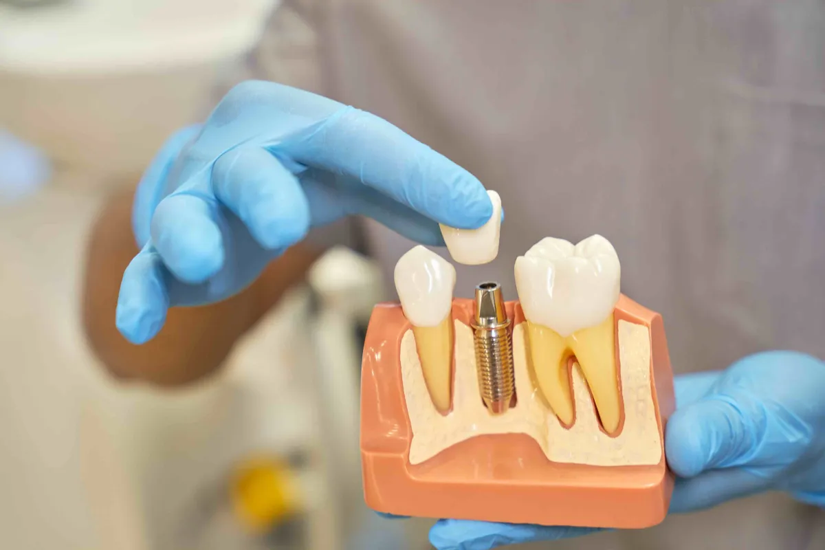 1-gunde-implant