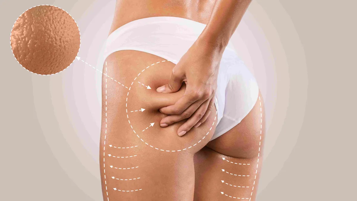 Alt Vücut Germe (Lower Body Lift)