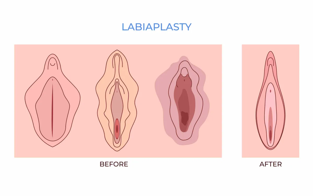 Labioplasti (İç Dudak Ameliyatı)