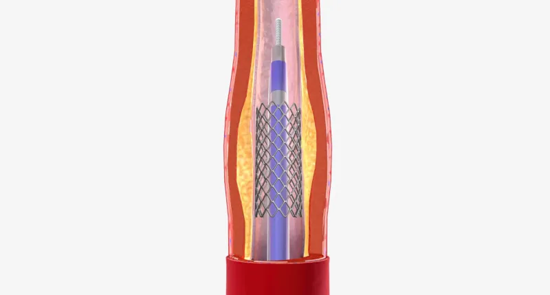 Balon ve Stent Uygulamaları Nedir, Nasıl Uygulanır?