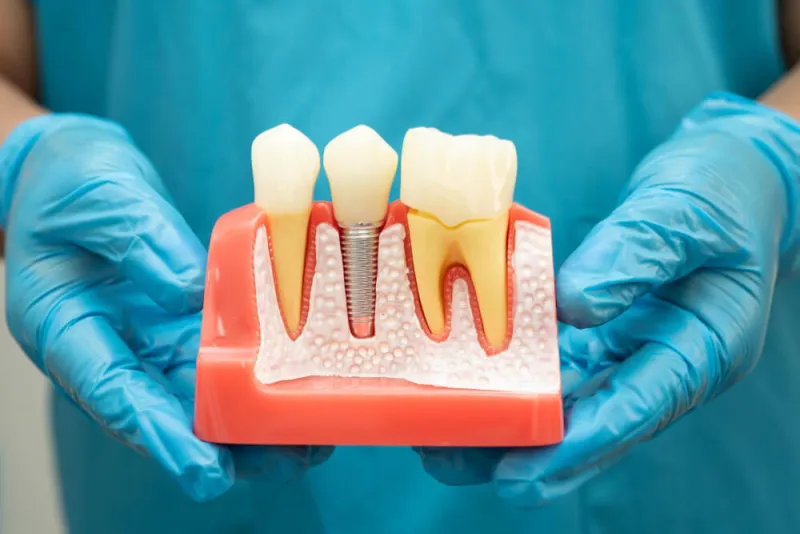 bütün dişlere implant yaptırılır mı