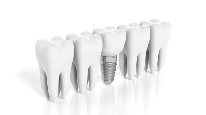 Şeker Hastası Olanlar İmplant Yaptırabilir mi?