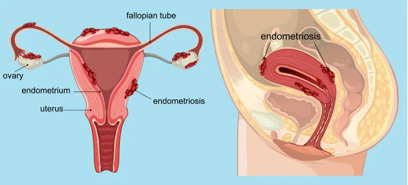 Endometriozis Çikolata Kisti