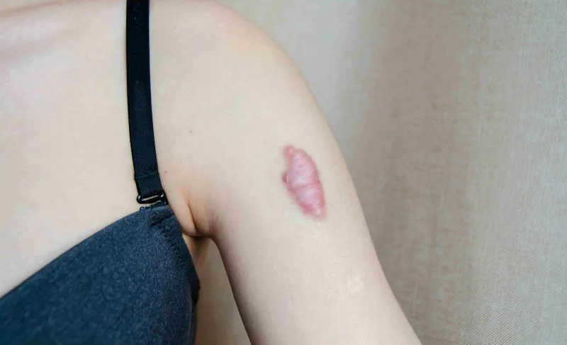 Keloid
