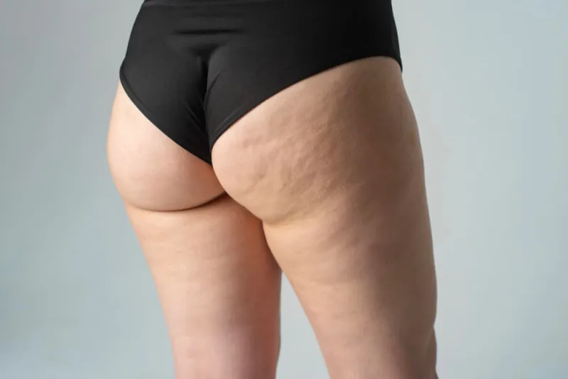 Liposuction Sonrası Dalgalanma Nasıl Geçer
