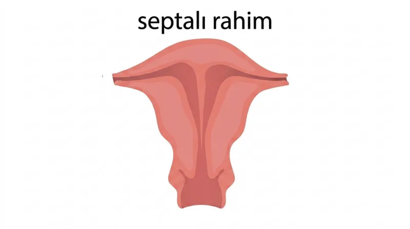 perdeli rahim (rahim semptumu)