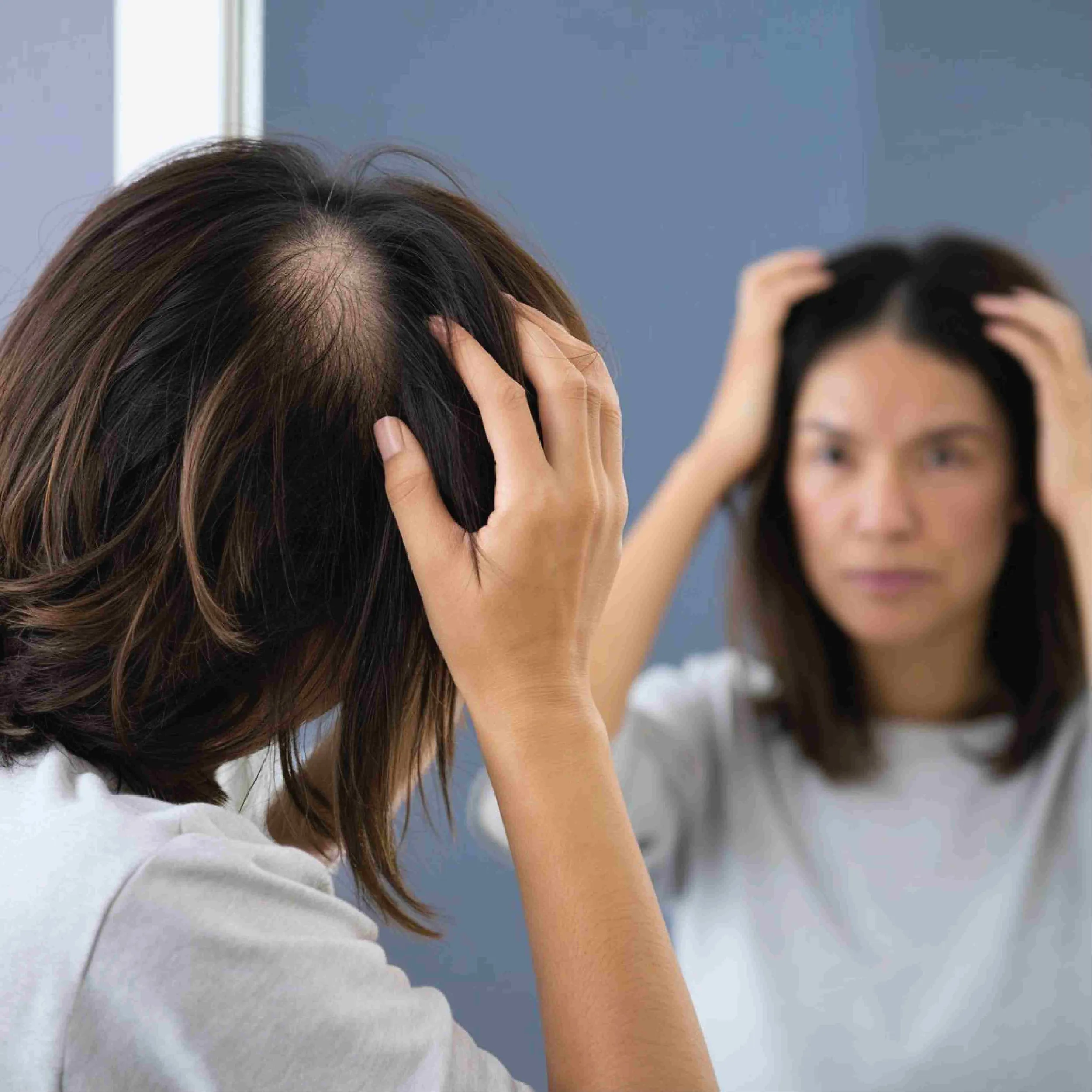 What is Hair Transplantation for Women and How is it Done?