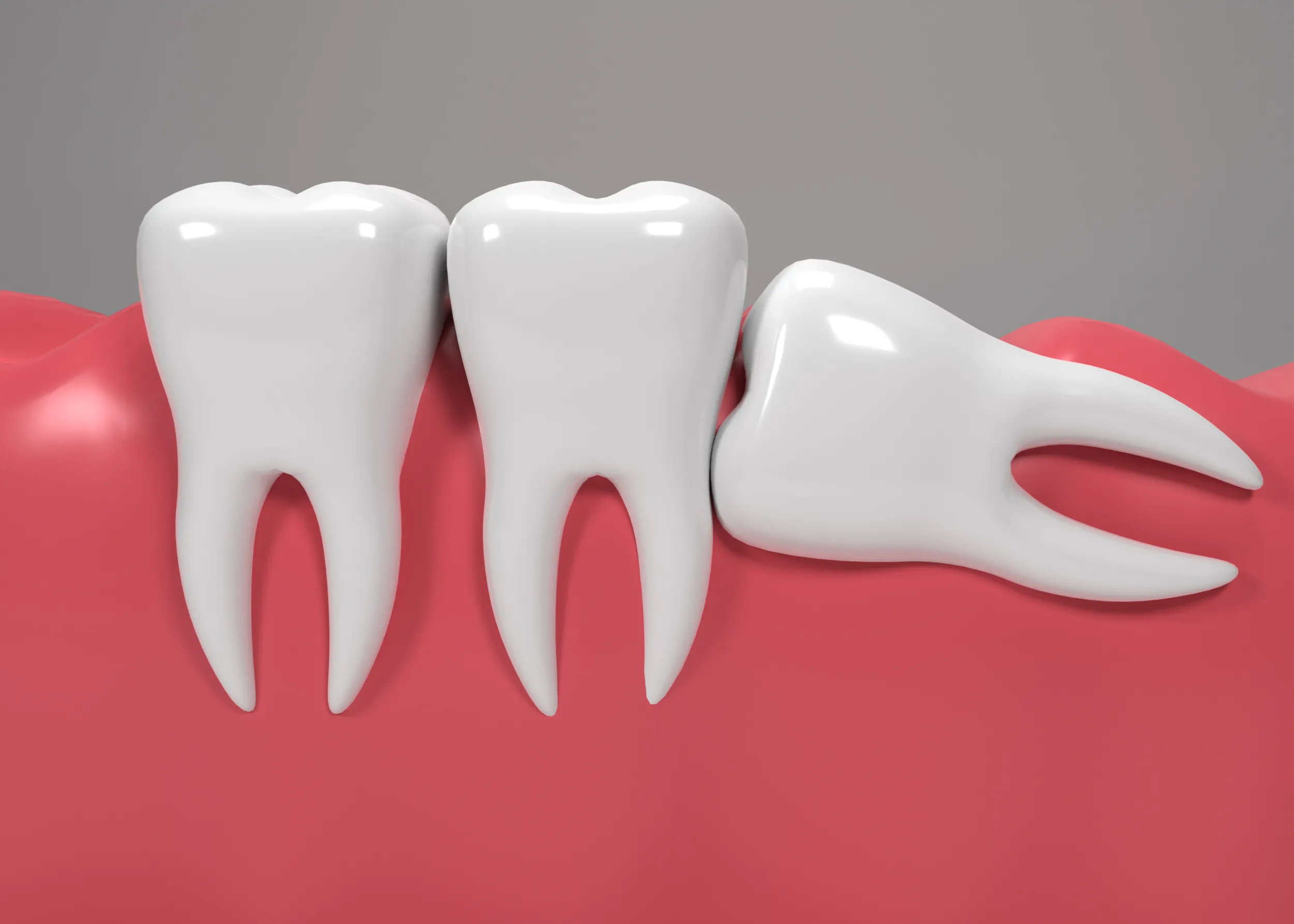 Wisdom Tooth Symptoms, Extraction, and Treatment Methods