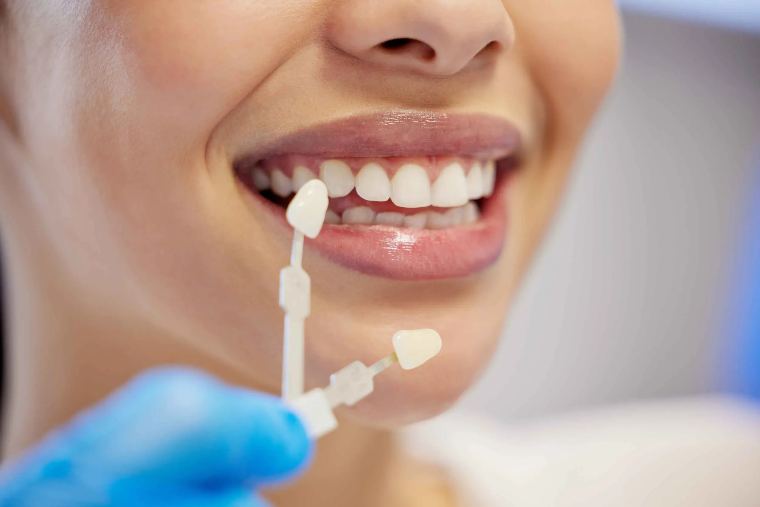 What Is Zirconia Veneering and How Is It Done?