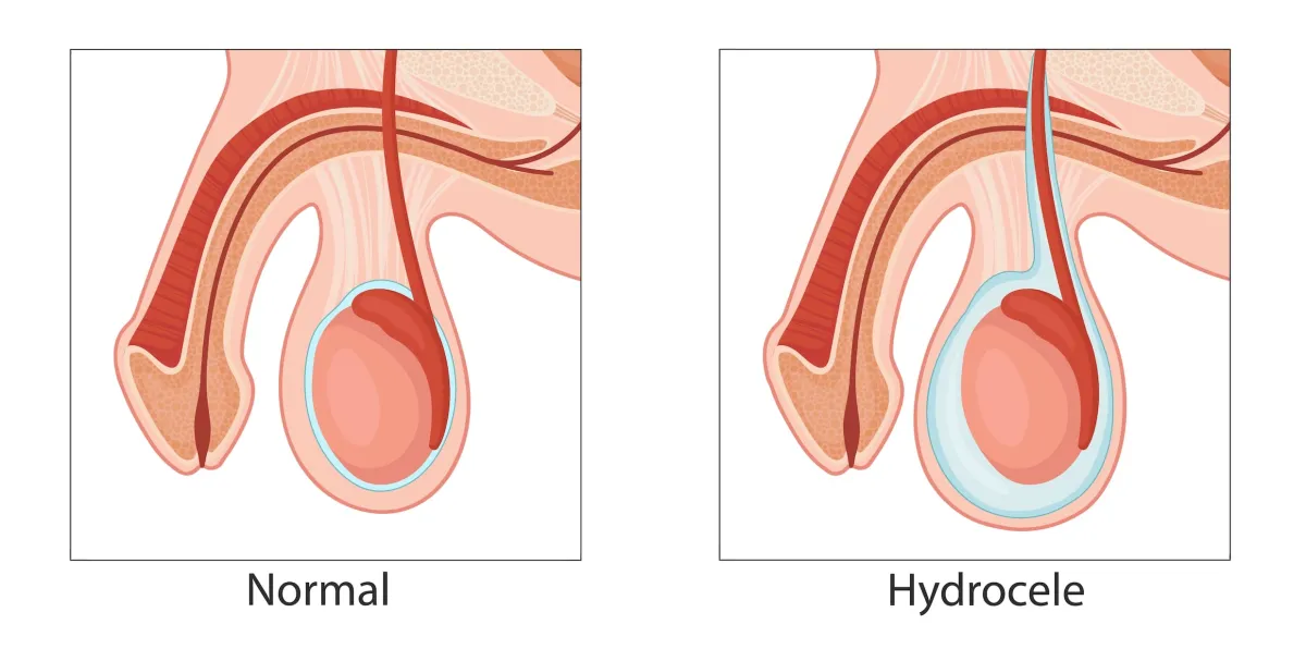 What Is A Hydrocele (Water Hernia)?