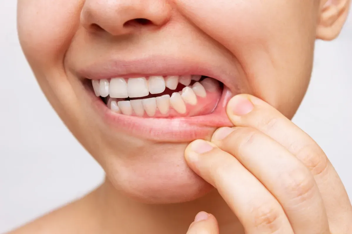 Gum Swelling