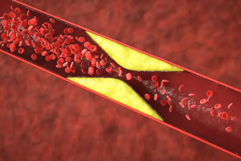What Is Hyperlipidemia (High Cholesterol) and What Are Its Symptoms?