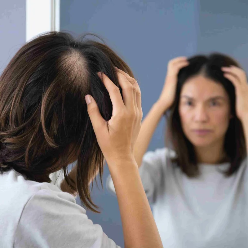 What is Hair Transplantation for Women and How is it Done?