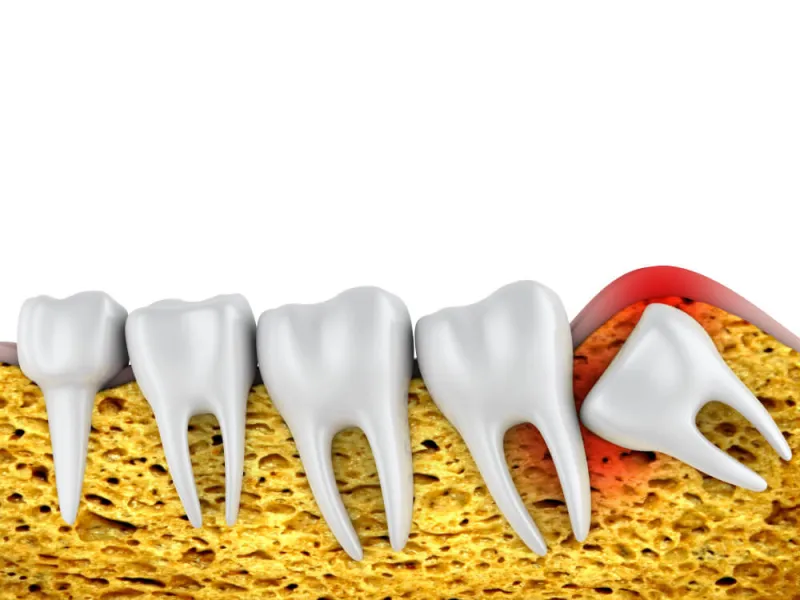 What Is An Impacted Tooth? How Is Impacted Tooth Treatment Performed?