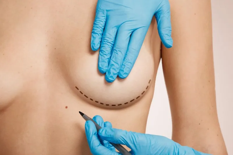  Breast Aesthetic Surgery Process for Patients Coming from Abroad
