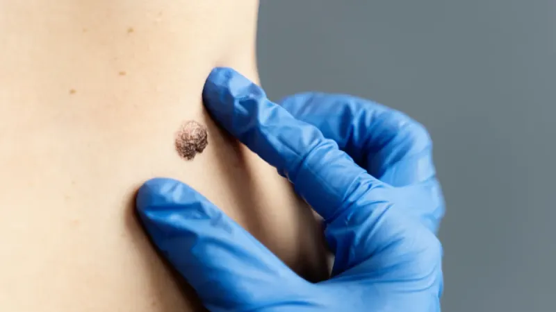 Genital Warts (Condyloma) Symptoms, Causes and Treatment